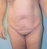 Tummy Tuck