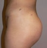 This 28 year old woman had liposuction around the buttocks and a large sized butt implant
