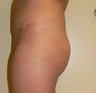 This 28 year old woman had liposuction around the buttocks and a large sized butt implant