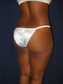 Brazilian Butt Lift 