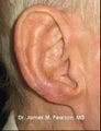 Facial Reconstruction / Mohs Reconstruction