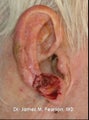 Facial Reconstruction / Mohs Reconstruction