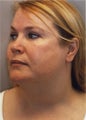 Neck Liposuction