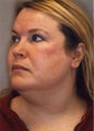Neck Liposuction