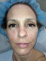 Ulthera and fillers
