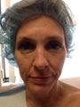 Ulthera and fillers