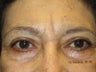 Eyelid Surgery
