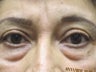 Eyelid Surgery