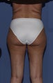 58 female treated with Vibro-liposuction