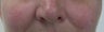 50 year old Female Treated for Rosacea and Facial Veins