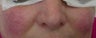50 year old Female Treated for Rosacea and Facial Veins