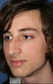 Rhinoplasty