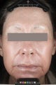 Female patient before and after CO2RE.