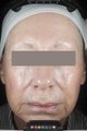 Female patient before and after CO2RE.