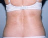 SmartLipo 