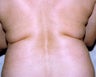 SmartLipo 