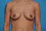 Breast Augmentation