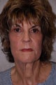 Photofacial, Melange Peel and Skin Tightening