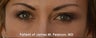 Lower Eyelid Rejuvenation (Tear Trough / Under Eye Hollows)