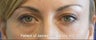 Lower Eyelid Rejuvenation (Tear Trough / Under Eye Hollows)