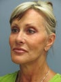 Facelift