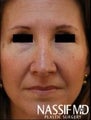 Female Revision Rhinoplasty 