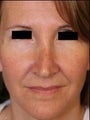 Female Revision Rhinoplasty 