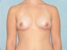 Fat Transfer