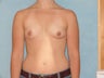 Fat Transfer