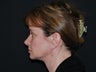 Facelift 3