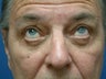 Eyelid Surgery