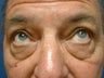 Eyelid Surgery