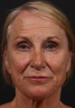 This patient underwent full face fractional CO2 laser resurfacing