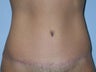 Tummy Tuck
