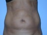 Tummy Tuck