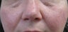 56 yeard old Female with facial veins