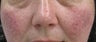 56 yeard old Female with facial veins