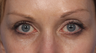 Eyelid Surgery