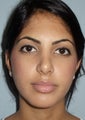 Nose Surgery