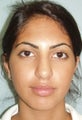 Nose Surgery