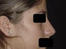 Rhinoplasty