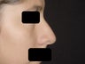 Rhinoplasty