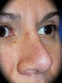 Rhinoplasty