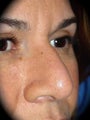 Rhinoplasty