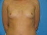30 yr old with Silicone Gel Breast Implants