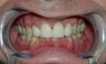 Smile Makeover