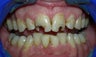 Smile Makeover