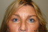 Eyelid Surgery