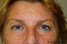 Eyelid Surgery