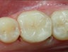 Patient Receives Composite Filling